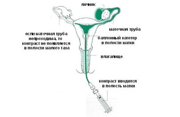 Схема эхогистеросальпингоскопии