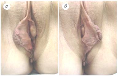 Травматическая деформация малых половых губ
