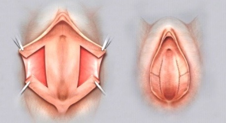 Схема клииновидной резекции малых половых губ