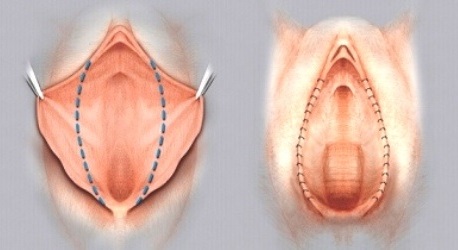 Схема краевой резекции малых половых губ
